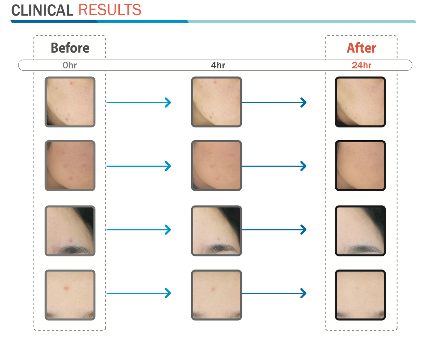 CLEANE Acne Therapy Device