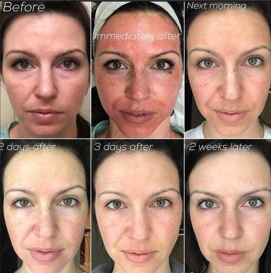 GBS Plasma Glow I