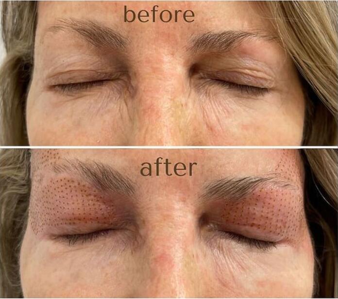 GBS Plasma Glow I