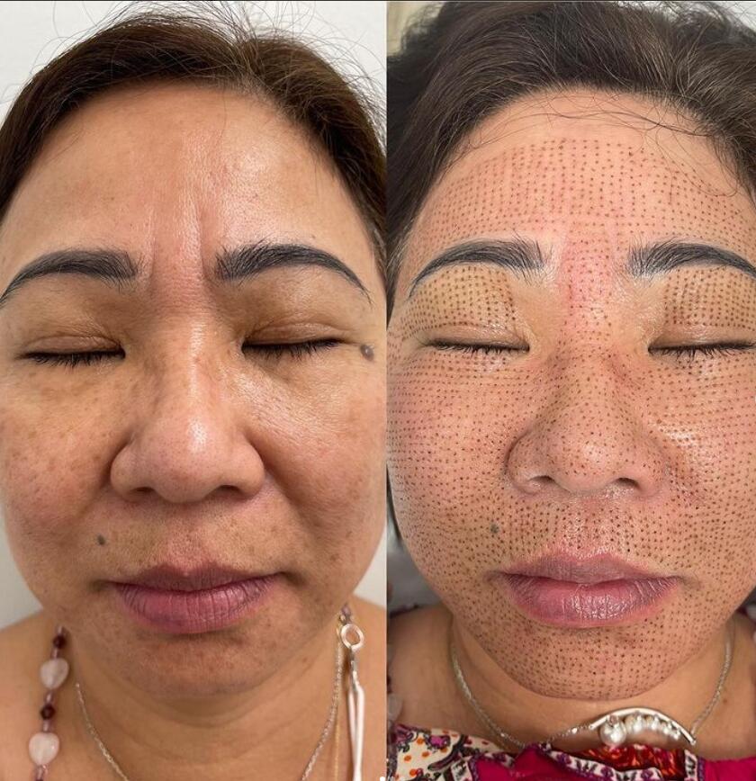 GBS Plasma Glow I