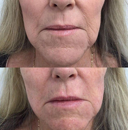 GBS Plasma Glow I