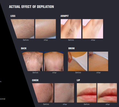 GBS Diolasheer Ice VL9 - Diode Laser Hair Removal