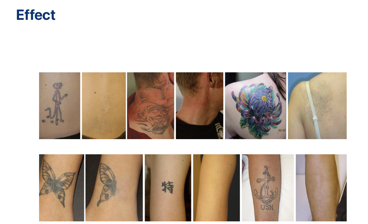  ND-YAG PRO X Display Tattoo Verwijdering & Huidverjonging