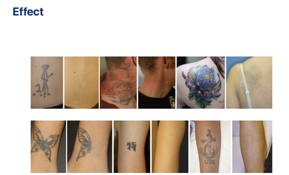  ND-YAG PRO X Display Tattoo Verwijdering & Huidverjonging
