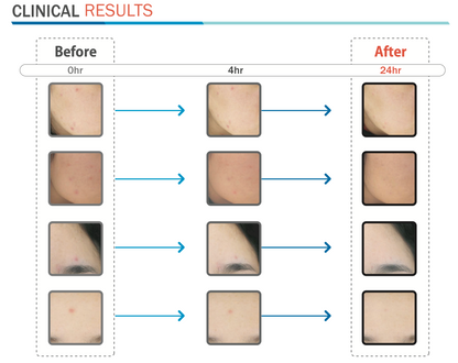 CLEANE Acne Therapy Device