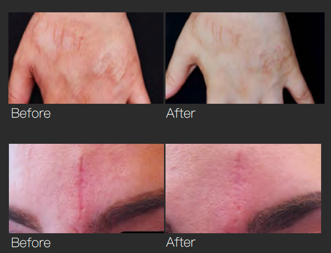 GBS Fractional RF Microneedling