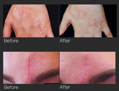 GBS Fractional RF Microneedling