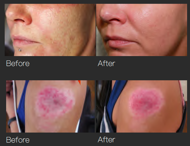 GBS Fractional RF Microneedling