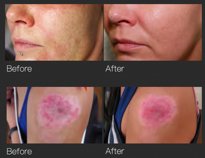 GBS Fractional RF Microneedling