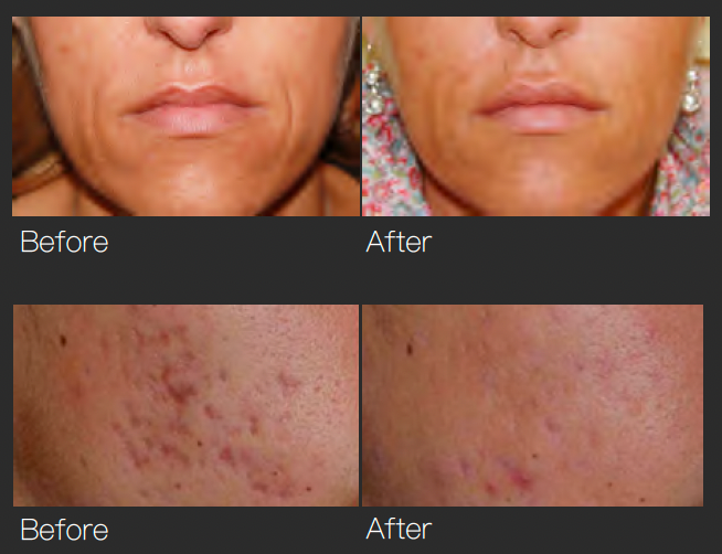 GBS Fractional RF Microneedling