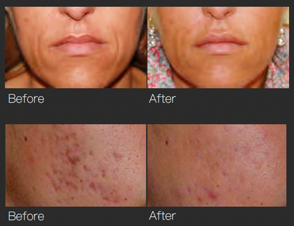 GBS Fractional RF Microneedling