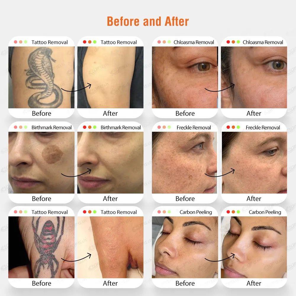  PicoSecond Laser Tattoo Verwijdering 