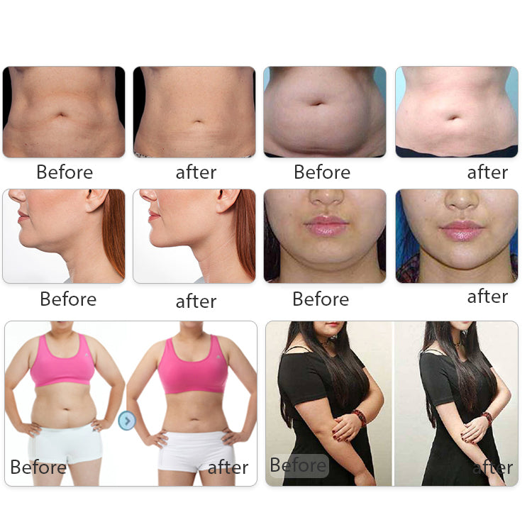 360 Cryolipolysis EMSlim