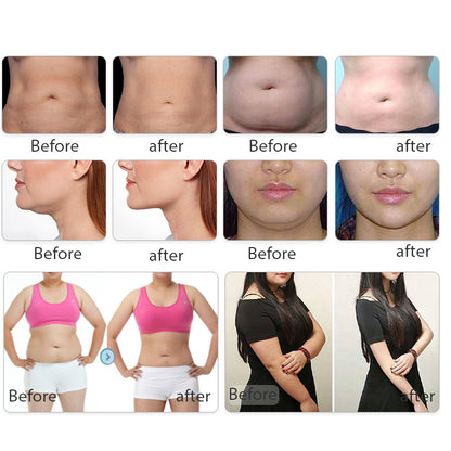 360 Cryolipolysis EMSlim